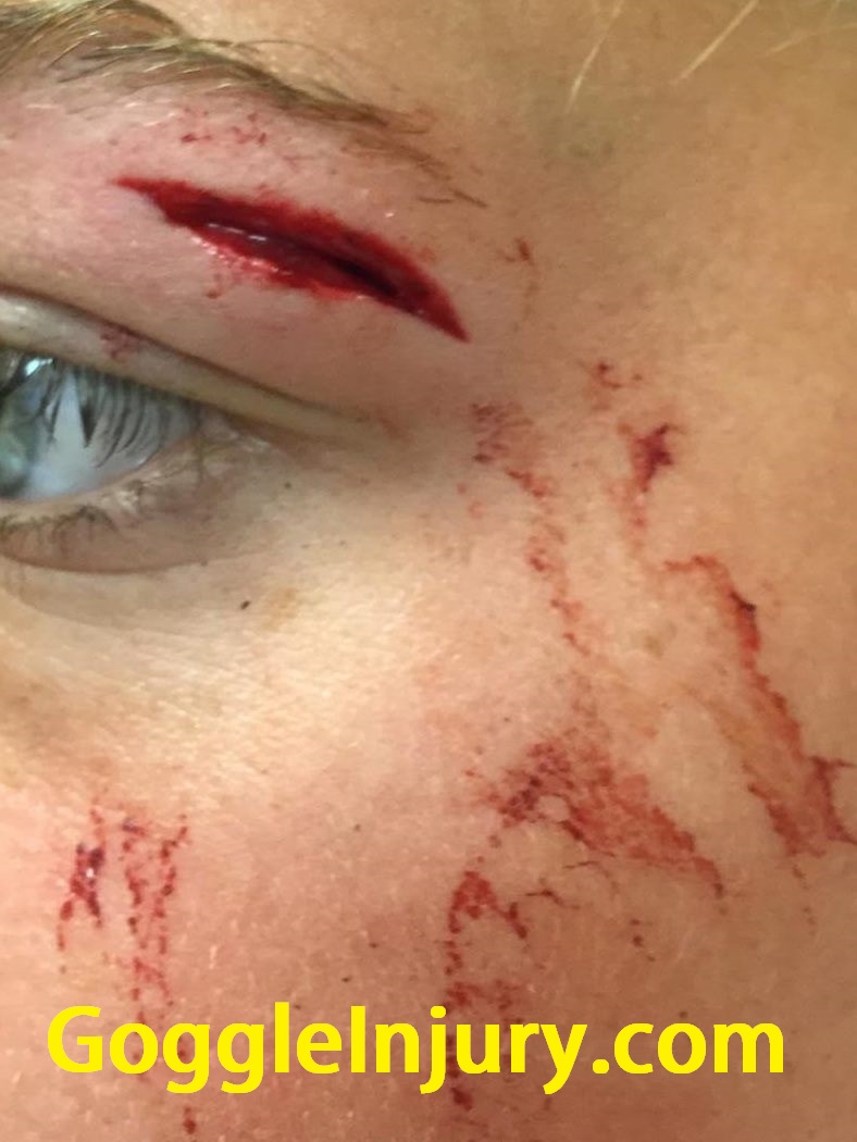 Field hockey injury caused by collision with athlete wearing goggles.