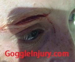 Field hockey injury caused by collision with athlete wearing goggles.
