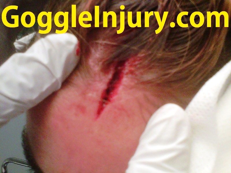 Field hockey scalp injury caused by collision with athlete wearing goggles.